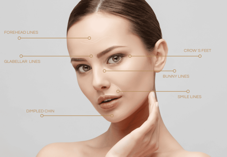 Anti-wrinkle botox treatment areas