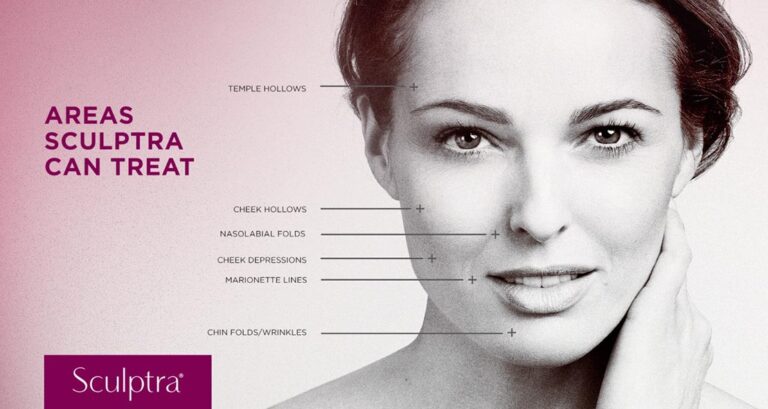 Areas Sculptra can treat, find us in Surrey.