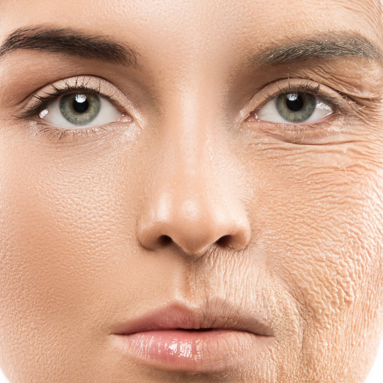 Before and after PRP Bio-Filler facial treatment in Woking