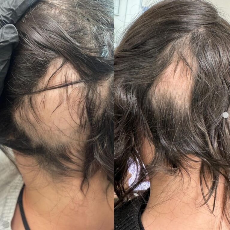 Before and after microneedling pen in Surrey for hair loss