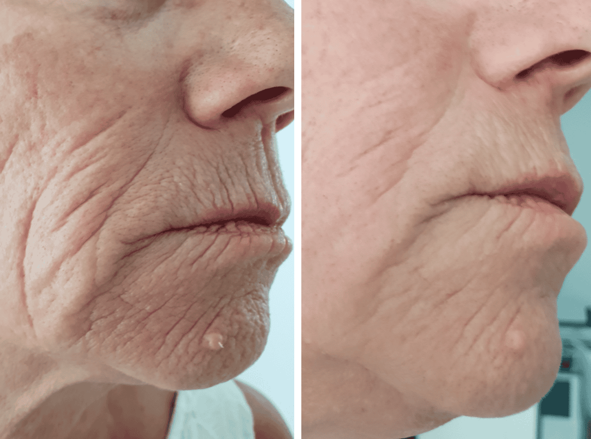 Microneedling pen treatment on face