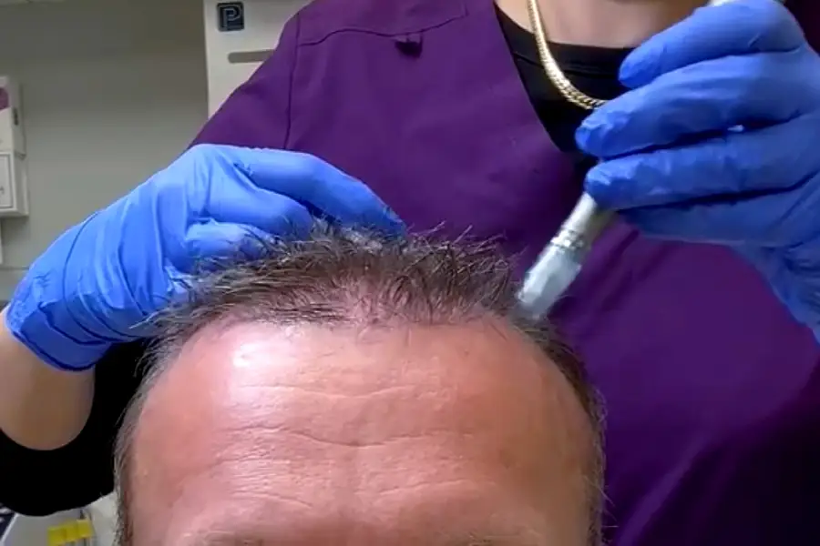 Microneedling pen for hair loss