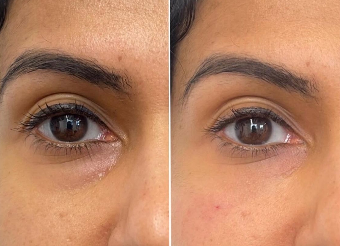 Polynucleotide or Salmon DNA results for Dark circles