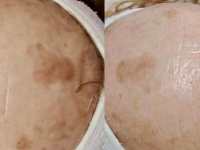 Chemical peel for pigmentation